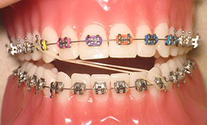 Cross elastics clearance orthodontics