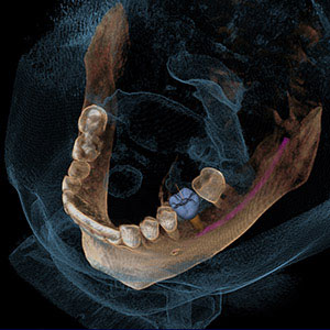 Cone Beam CT or CBCT x-ray taken prior to braces