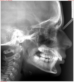 Cephalometric x-ray taken prior to braces