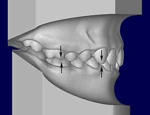 Model showing a class 1 malocclusion