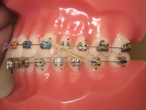 Rubber Bands and Elastics for Braces