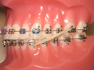Class 3 rubber bands for braces to correct an underbite