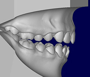 Model showing a class 1 malocclusion