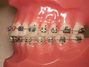 Vertical elastics for braces to bring teeth together