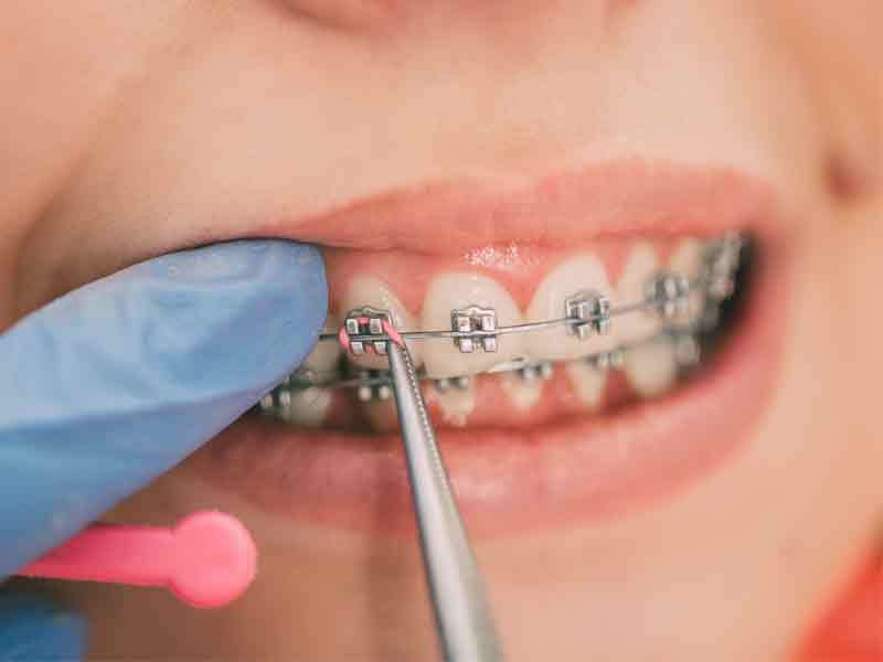 What Are Elastics for Braces?