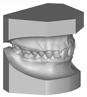 Digital model of the teeth before braces