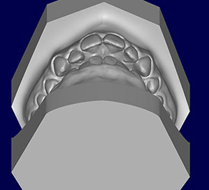 Model showing a class 1 malocclusion