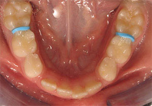 Separator or spacer for braces